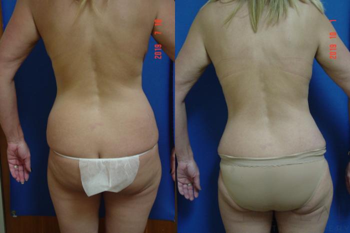 Before & After Liposuction Case 365 View #4 View in San Jose, CA