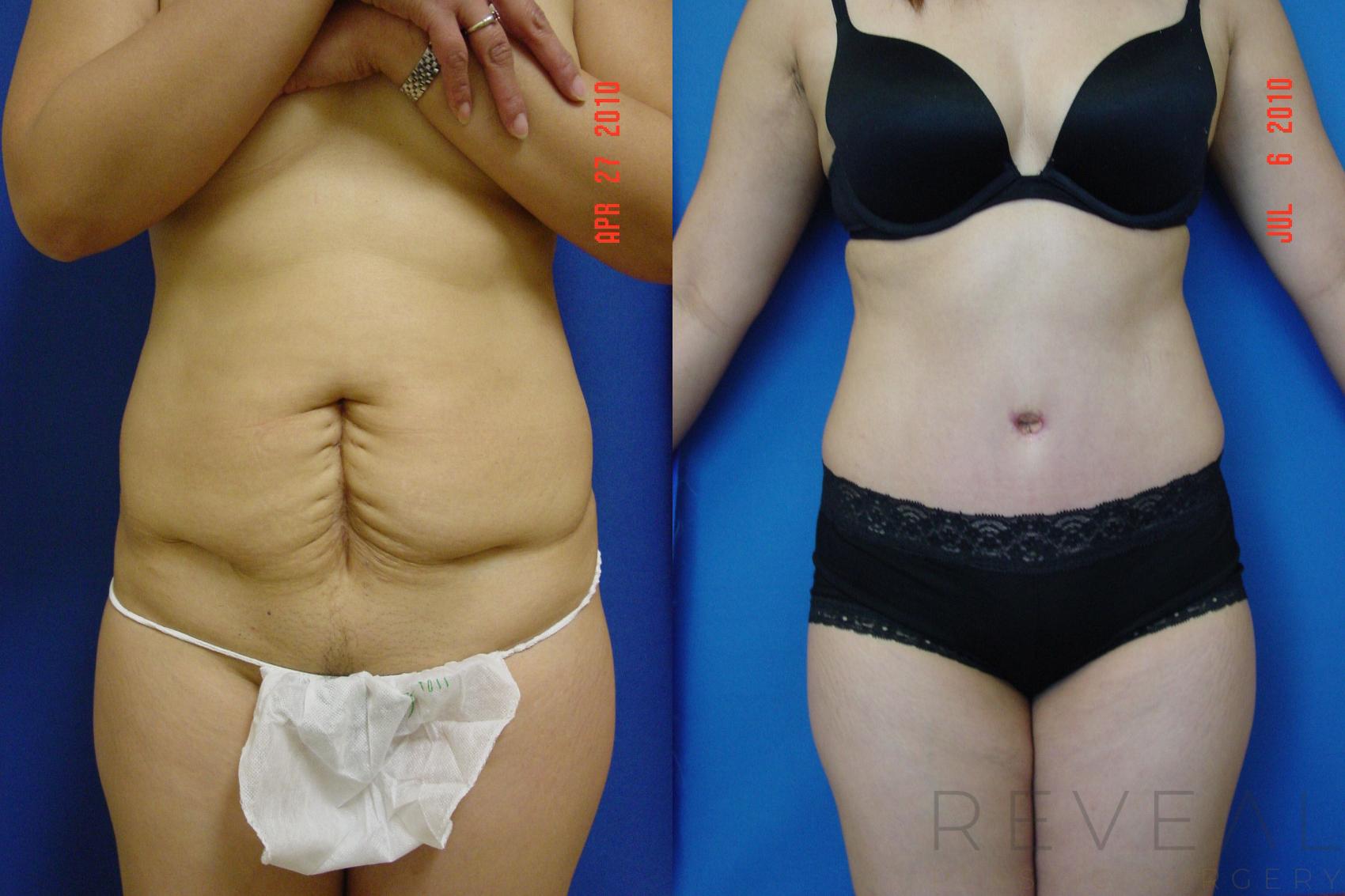 Before & After Tummy Tuck Case 39 View #1 View in San Jose, CA