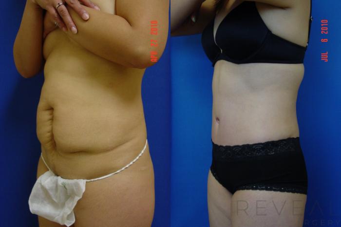 Before & After Liposuction Case 39 View #2 View in San Jose, CA