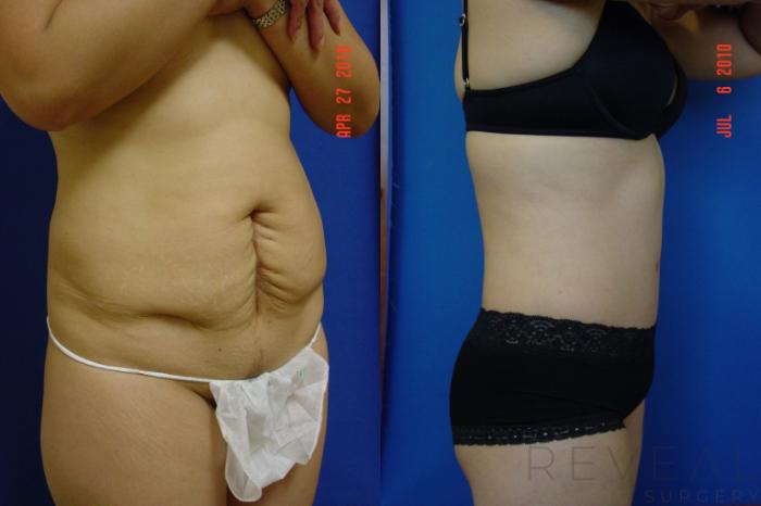 Tummy Tuck Before & After Gallery: Patient 27