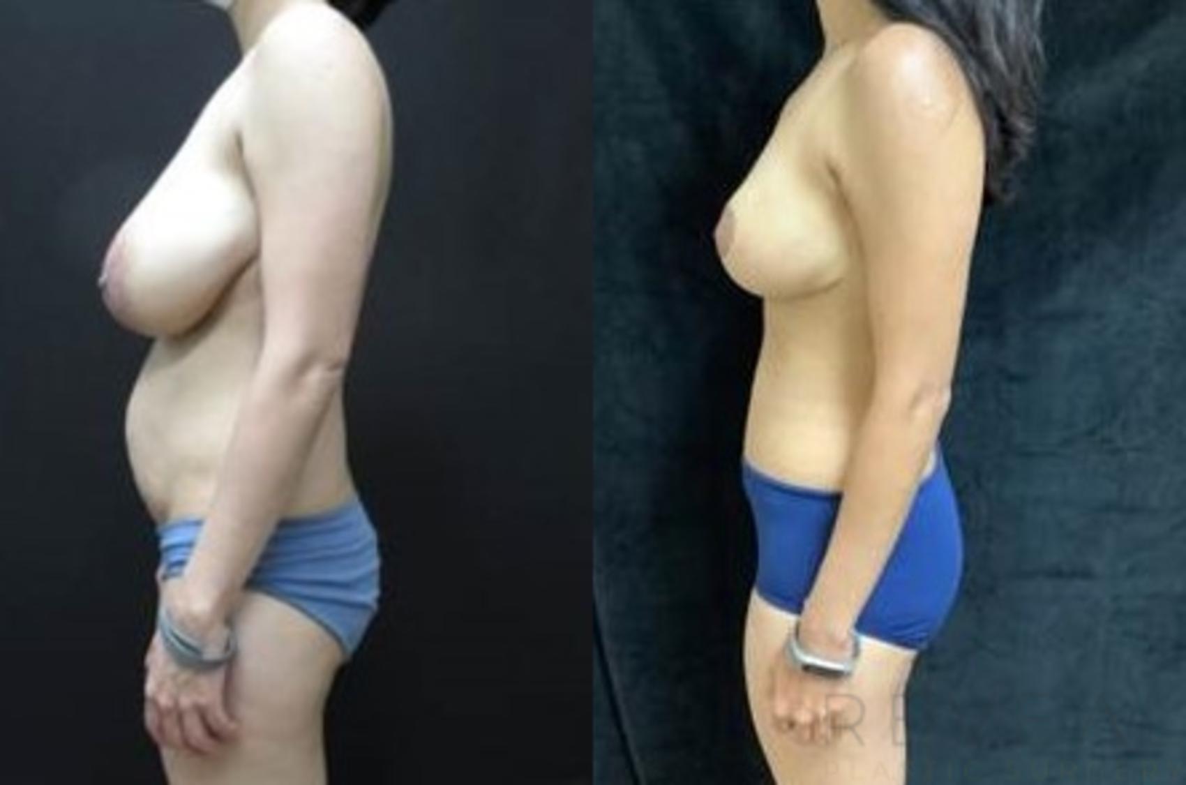Before & After Breast Augmentation Case 409 View #1 View in San Jose, CA
