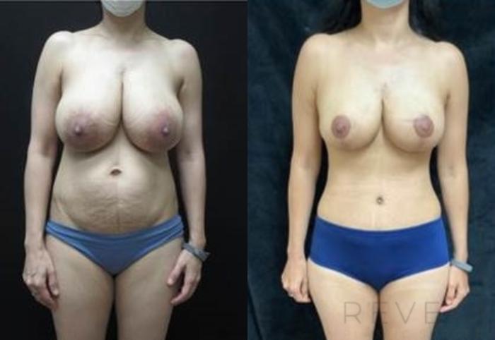 Before & After Tummy Tuck Case 409 View #2 View in San Jose, CA