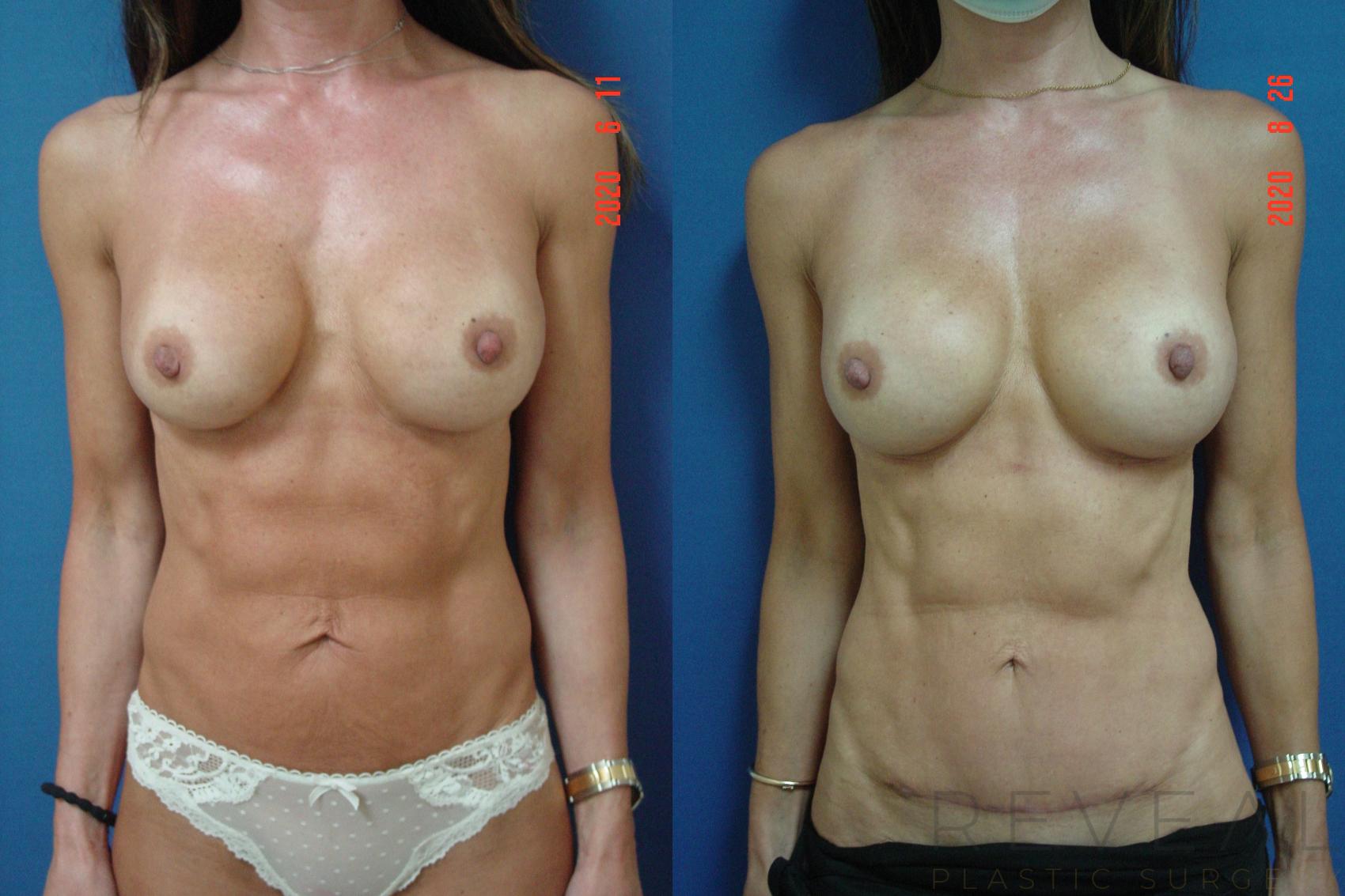 Before & After Breast Implants Case 417 View #1 View in San Jose, CA