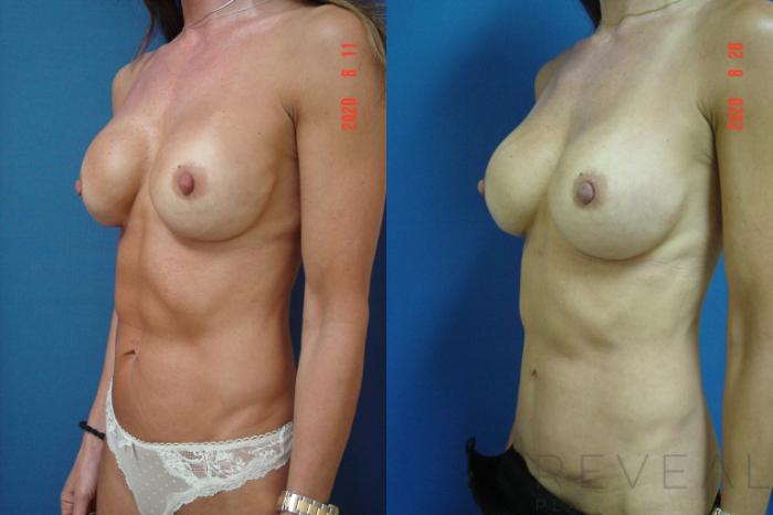 Before & After Breast Implants Case 417 View #2 View in San Jose, CA