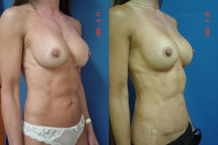 Before & After Tummy Tuck Case 417 View #3 View in San Jose, CA