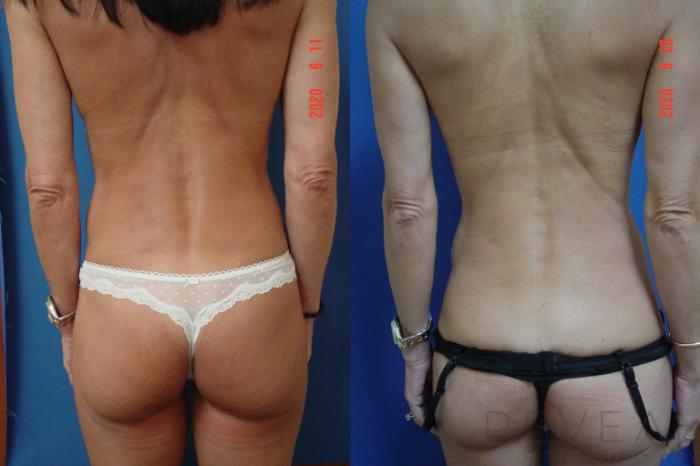 Before & After Tummy Tuck Case 417 View #4 View in San Jose, CA