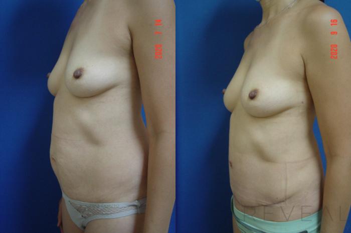 Before & After Liposuction Case 428 View #1 View in San Jose, CA