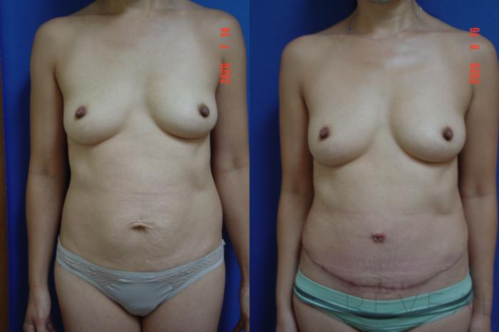 Before & After Liposuction Case 428 View #3 View in San Jose, CA
