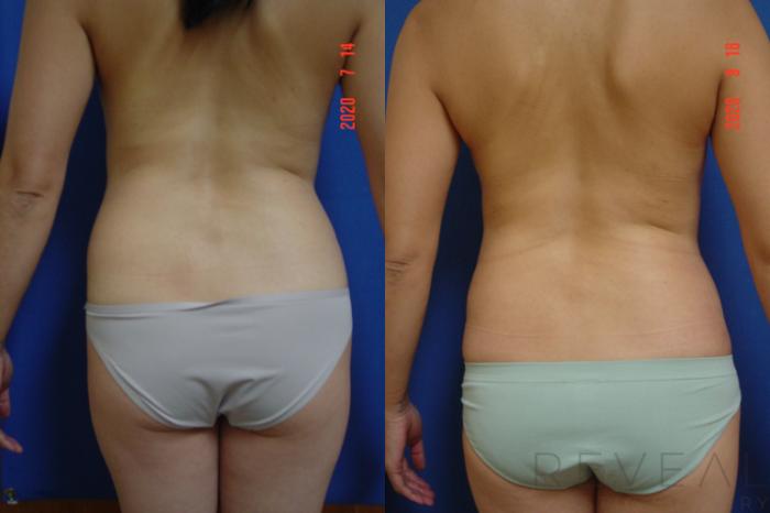 Before & After Tummy Tuck Case 428 View #4 View in San Jose, CA