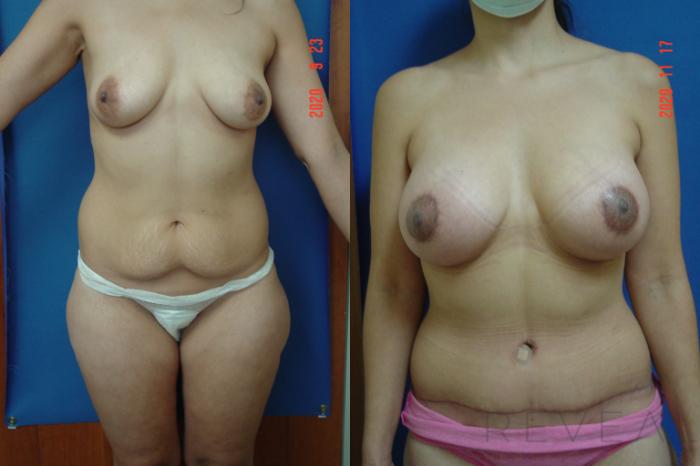 Before & After Liposuction Case 447 View #1 View in San Jose, CA