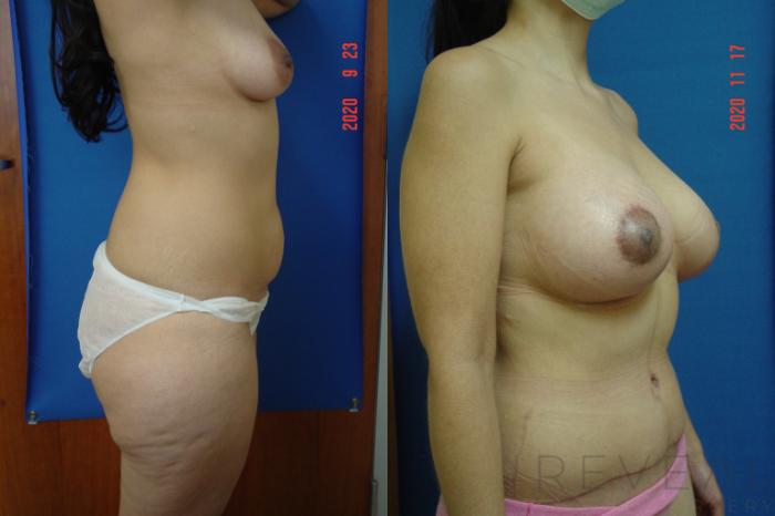 Before & After Breast Augmentation Case 447 View #3 View in San Jose, CA