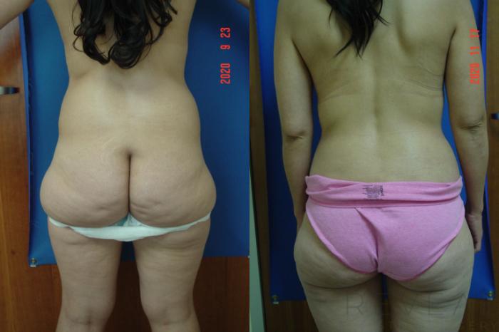 Before & After Liposuction Case 447 View #4 View in San Jose, CA
