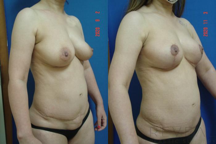 Before & After Liposuction Case 452 View #1 View in San Jose, CA