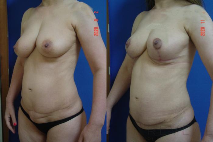 Before & After Liposuction Case 452 View #2 View in San Jose, CA