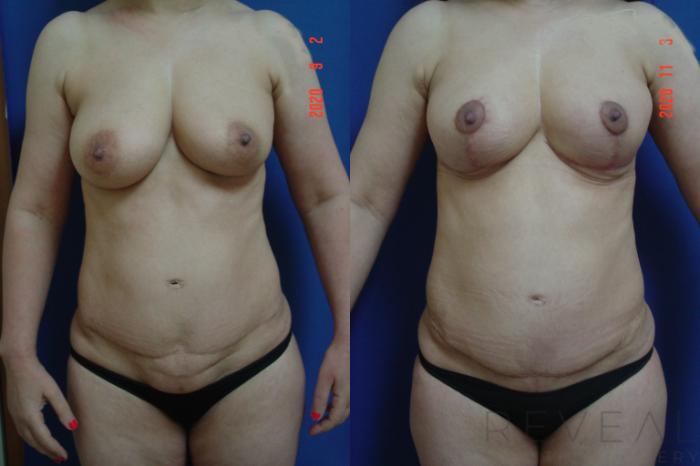 Before & After Liposuction Case 452 View #3 View in San Jose, CA
