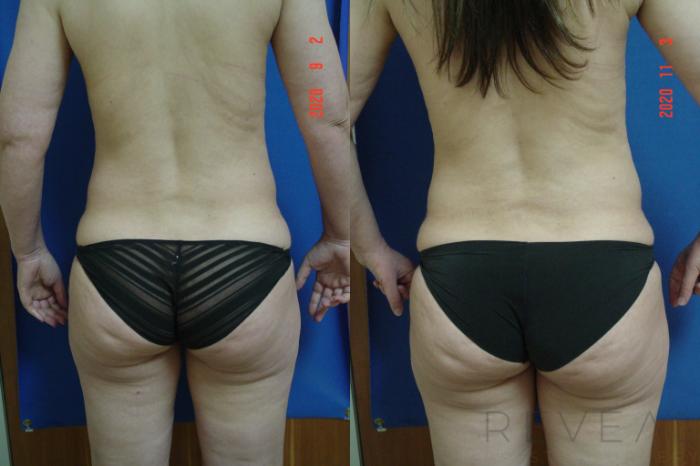 Before & After Liposuction Case 452 View #4 View in San Jose, CA