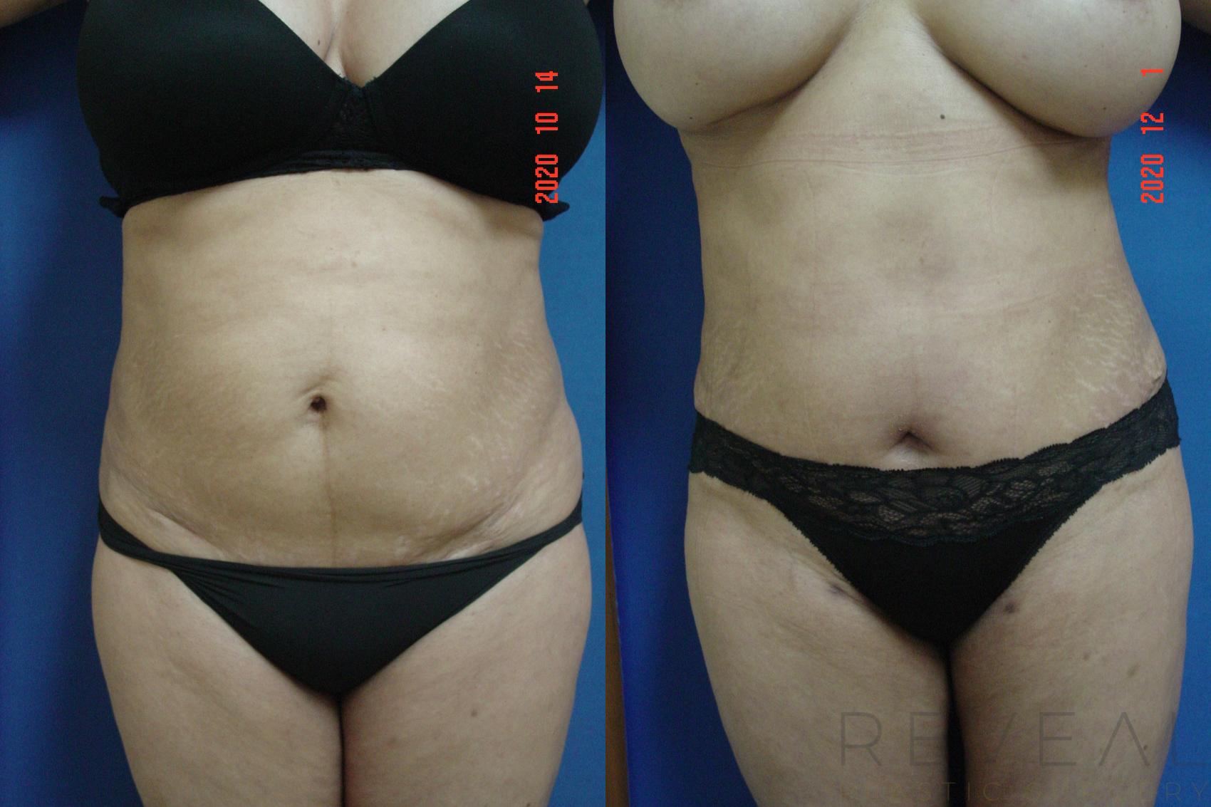 Before & After Tummy Tuck Case 456 View #1 View in San Jose, CA