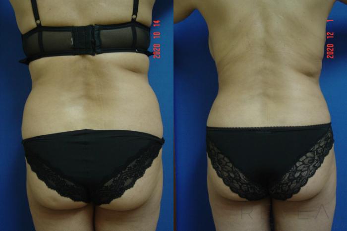Before & After Tummy Tuck Case 456 View #2 View in San Jose, CA