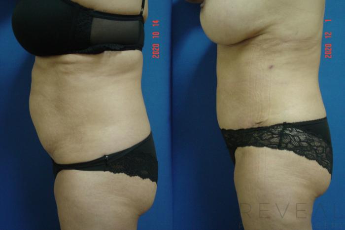 Before & After Tummy Tuck Case 456 View #3 View in San Jose, CA