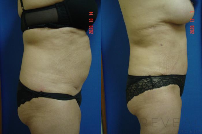 Before & After Tummy Tuck Case 456 View #4 View in San Jose, CA