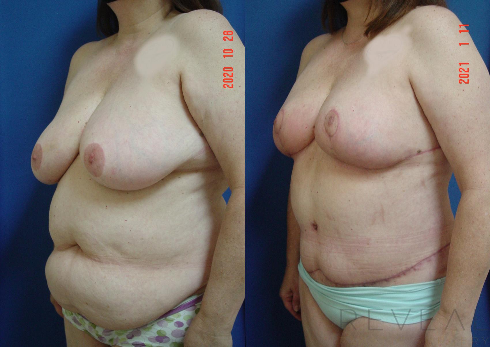 Before & After Breast Reduction Case 509 View #1 View in San Jose, CA