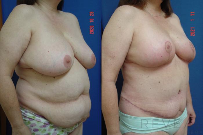 Before & After Breast Reduction Case 509 View #2 View in San Jose, CA