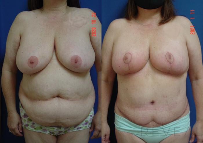 Before & After Breast Lift Case 509 View #3 View in San Jose, CA