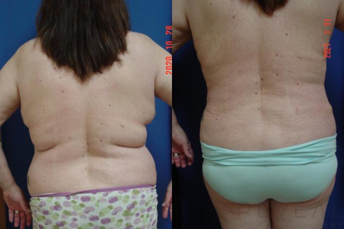 Before & After Breast Lift Case 509 View #4 View in San Jose, CA