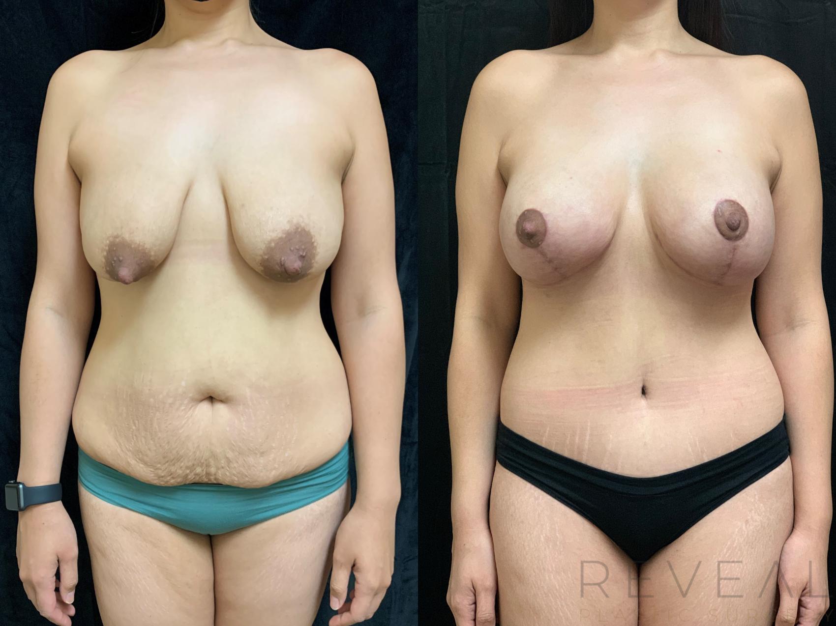 Before & After Breast Lift Case 510 View #1 View in San Jose, CA