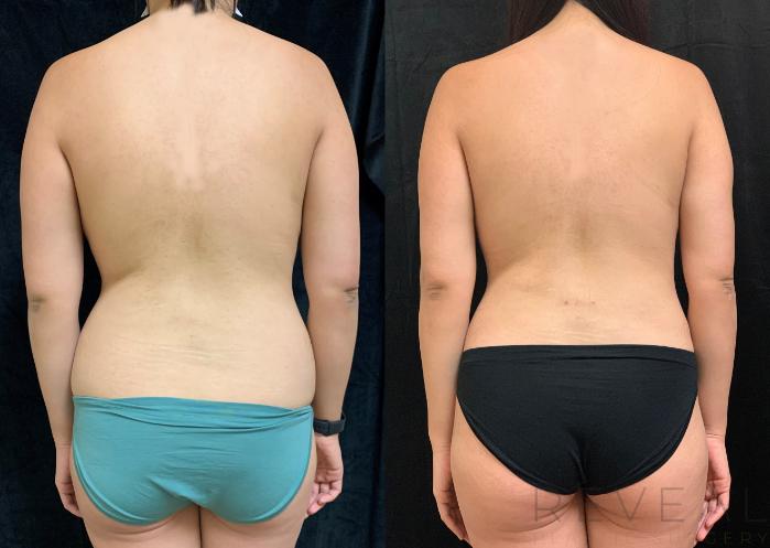 Before & After Tummy Tuck Case 510 View #2 View in San Jose, CA