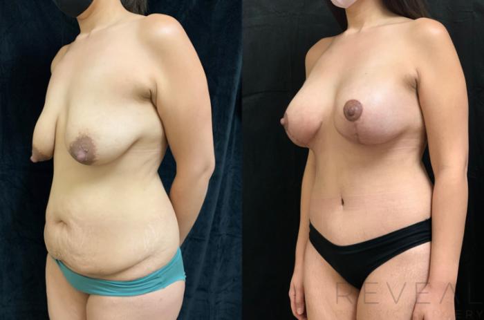 Before & After Tummy Tuck Case 510 View #4 View in San Jose, CA