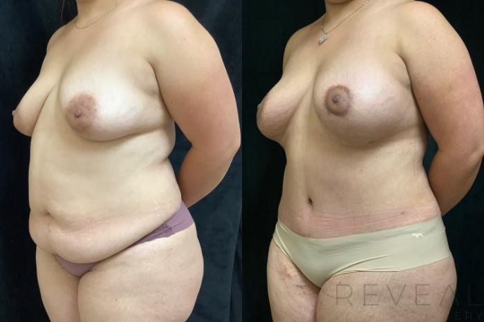 Before & After Breast Augmentation Case 513 View #1 View in San Jose, CA