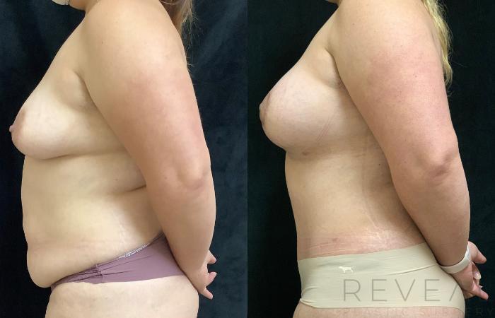 Before & After Tummy Tuck Case 513 View #2 View in San Jose, CA