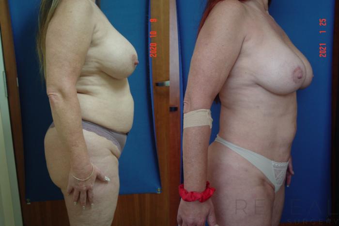 Before & After Breast Augmentation Case 521 View #2 View in San Jose, CA