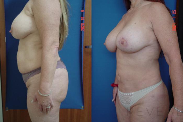 Before & After Breast Augmentation Case 521 View #3 View in San Jose, CA