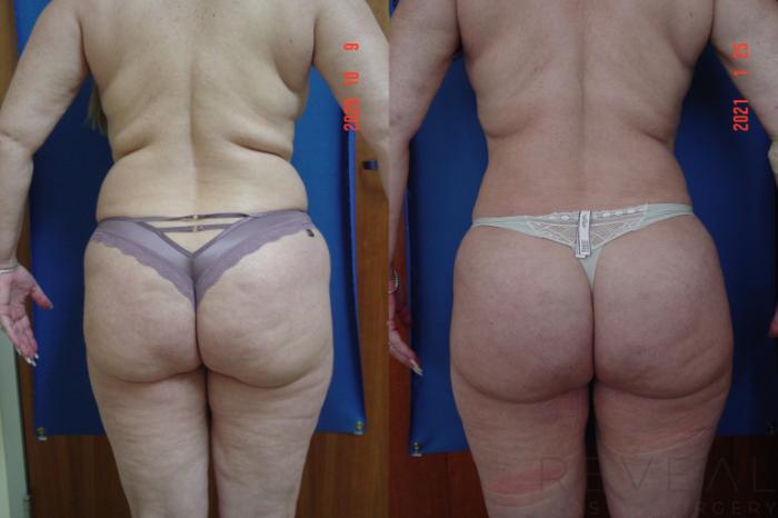 Before & After Brazilian Butt Lift Case 521 View #4 View in San Jose, CA