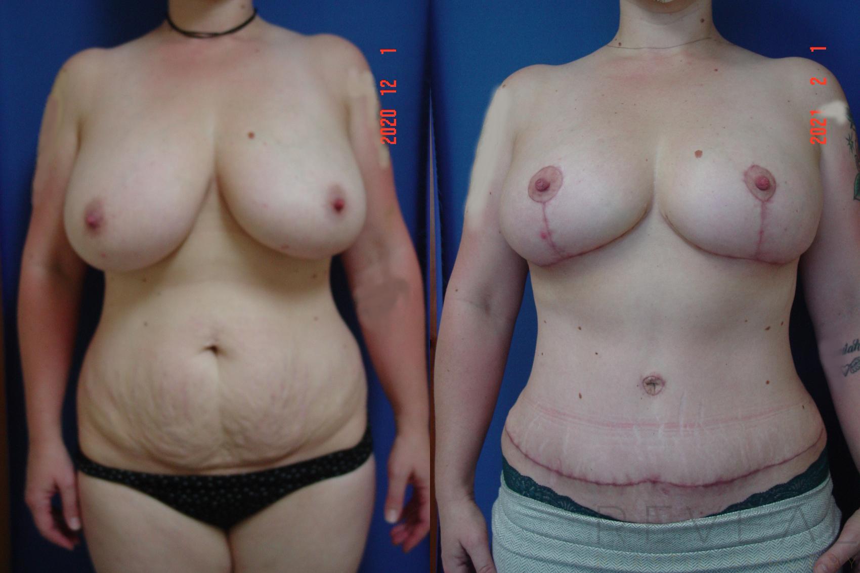 Before & After Liposuction Case 531 View #1 View in San Jose, CA