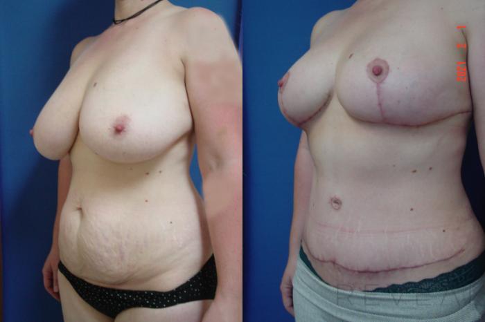 Before & After Liposuction Case 531 View #2 View in San Jose, CA