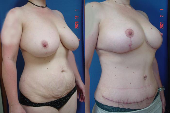 Before & After Liposuction Case 531 View #3 View in San Jose, CA