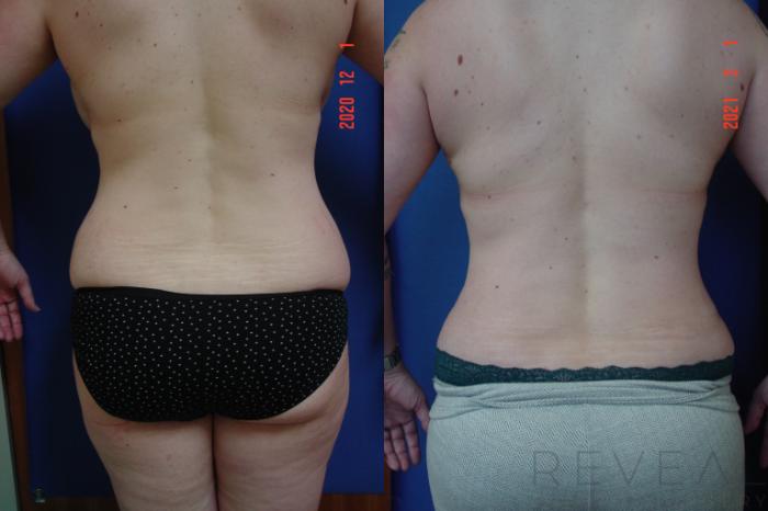 Before & After Liposuction Case 531 View #4 View in San Jose, CA