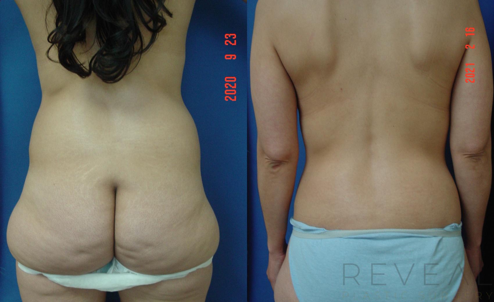 Before & After Tummy Tuck Case 539 View #1 View in San Jose, CA
