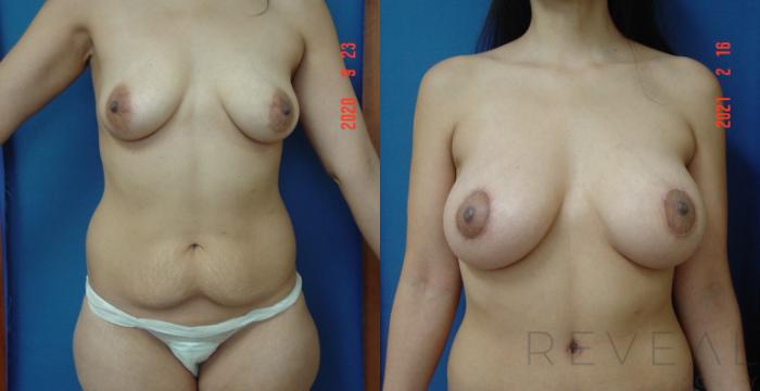 Before & After Breast Augmentation Case 539 View #2 View in San Jose, CA