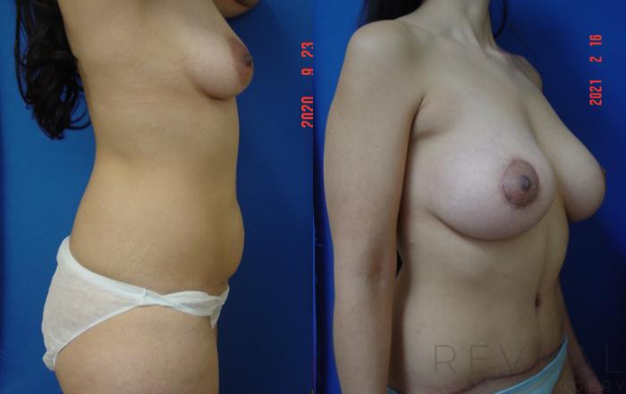 Before & After Breast Augmentation Case 539 View #4 View in San Jose, CA