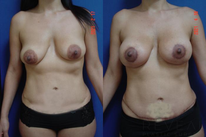 Before & After Breast Lift Case 552 View #1 View in San Jose, CA