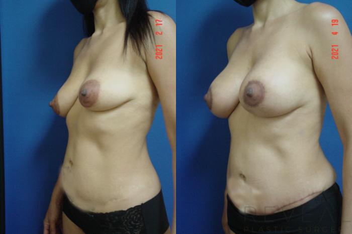 Before & After Breast Lift Case 552 View #2 View in San Jose, CA