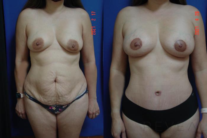 Before & After Fat Transfer to Breasts Case 555 View #1 View in San Jose, CA