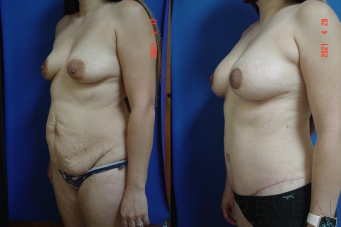 Before & After Fat Transfer to Breasts Case 555 View #2 View in San Jose, CA