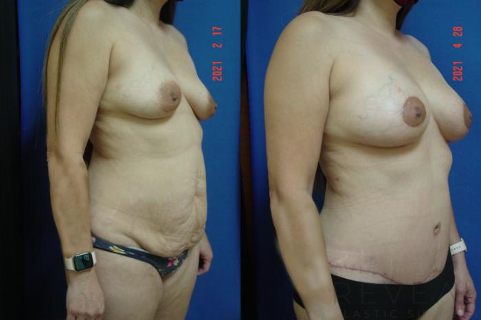 Before & After Fat Transfer to Breasts Case 555 View #3 View in San Jose, CA