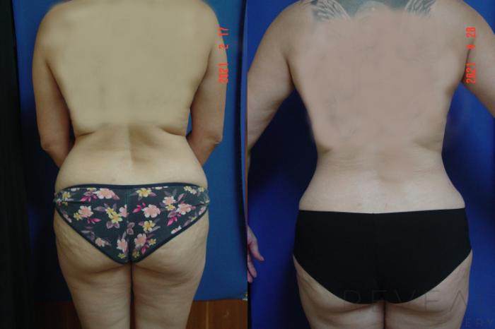 Before & After Tummy Tuck Case 555 View #4 View in San Jose, CA