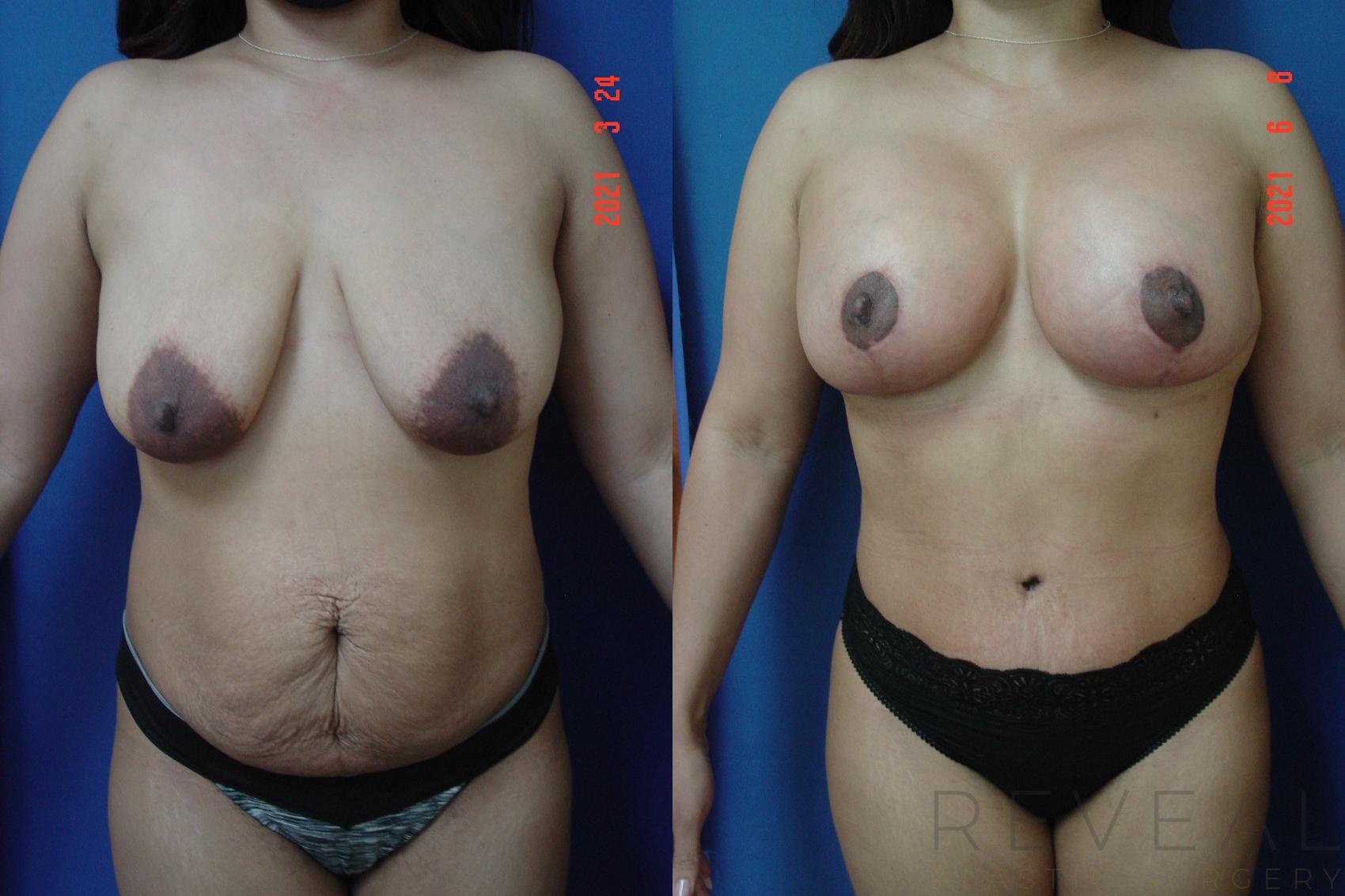 Before & After Breast Augmentation Case 565 View #1 View in San Jose, CA